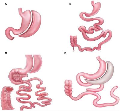 Can we abandon foregut exclusion for an ideal and safe metabolic surgery?